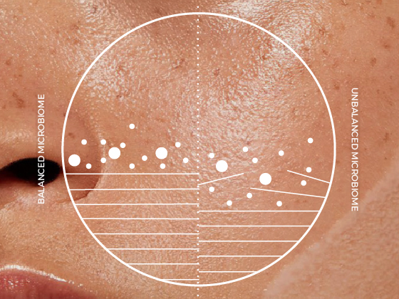 Blog Images-01 Close-up of skin texture with a circular graph overlay. The graph displays "Balanced Microbiome" on the left and "Unbalanced Microbiome" on the right, with various data points and lines illustrating differences.